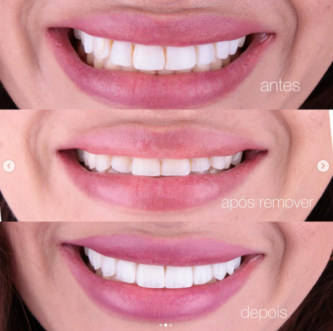 Resultado de tratamento odontológico